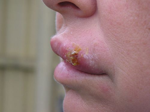 Facts about Herpes