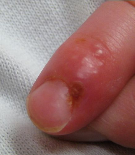 Herpes Pictures