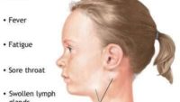 10 Interesting Facts about Mononucleosis