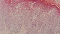 10 Interesting Facts about Warts